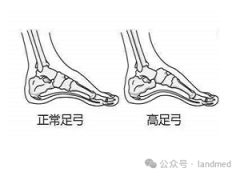 “足”以惊人 | 高弓足矫